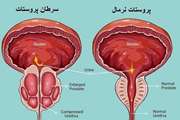 عوارض جانبی مرتبط با درمان سرطان پروستات